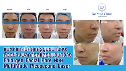 แนะนำเทคนิคดูแลรูขุมขนกว้าง: ตัวอย่างผลการดูแลรูขุมขนกว้าง Enlarged Facial Pore ด้วย MultiMode Picosecond Laser